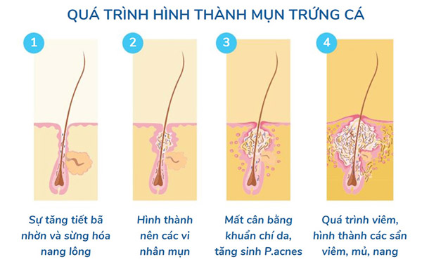 Hiện tượng mụn trứng cá ở tuổi dậy thì chủ yếu là do sự tăng cường hoạt động của bộ phận tuyến nhờn